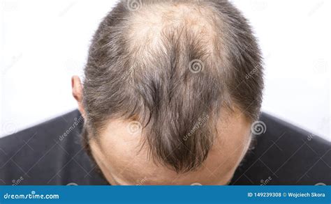 Balding Hairstyles Young Men