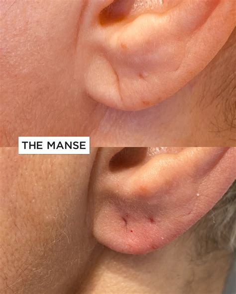 Ear Lobe Ageing Treatment - Best Cosmetic Clinic Sydney. Advanced