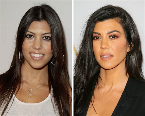 Kardashian Sisters: Who's Gotten the Most Surgery?