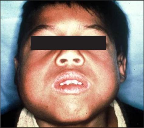 cherubism clinicoradiographic features  treatment pmc