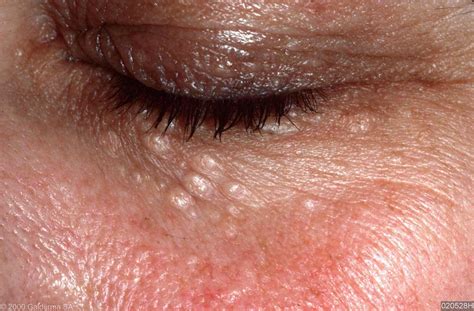 syringomas