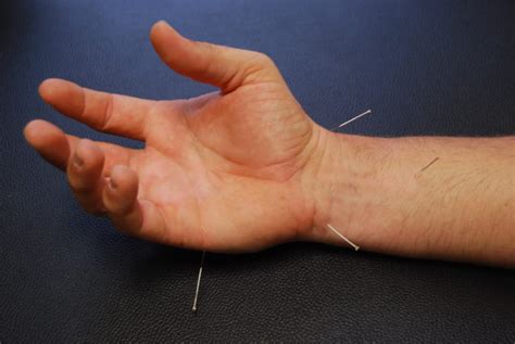 Acupuncture for Hand and Wrist Pain - Synergy Chiropractic of Houston