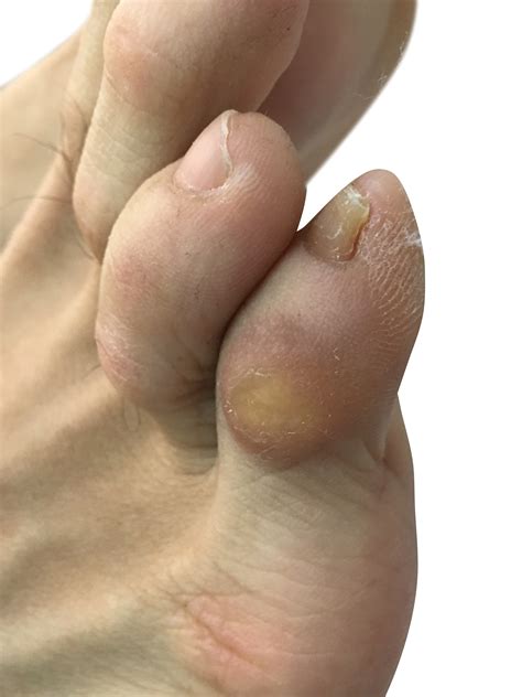 Corn Under Big Toe at Robyn Morgan blog