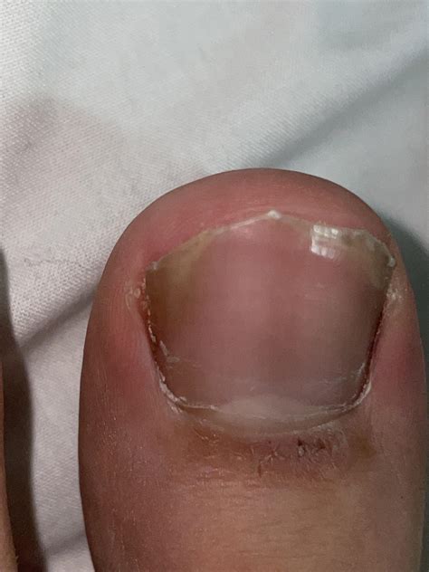left side of my toe hurts what is it : r/Ingrown_Toenails