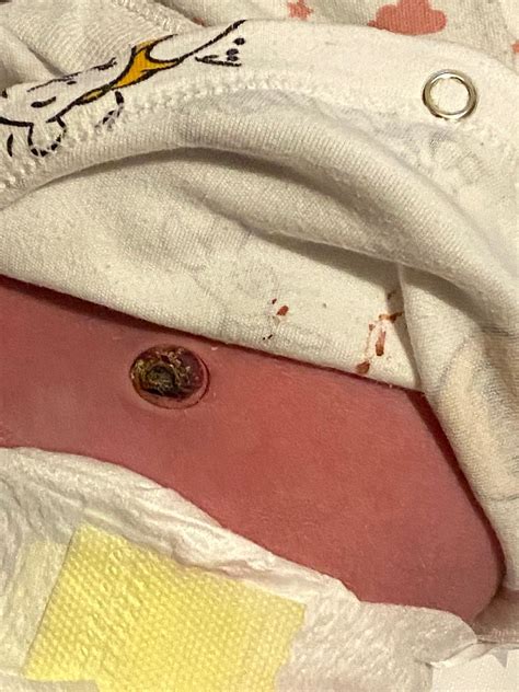 Worried belly is infected after umbilical cord fell off | BabyCenter