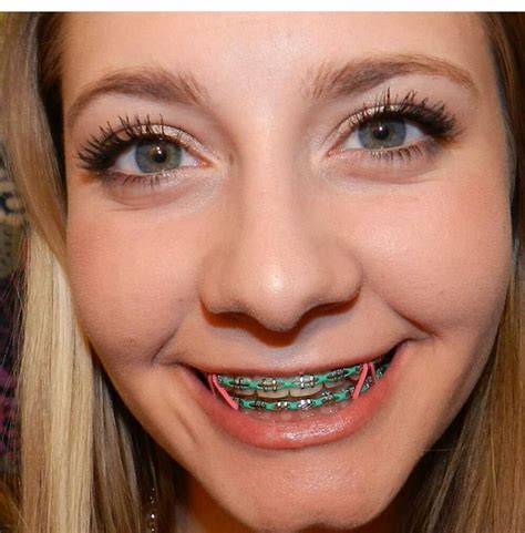 Pin by elpotrillo31 on Braces | Braces colors, Cute braces, Dental braces