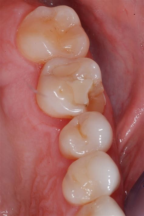 CEREC crown start to finish