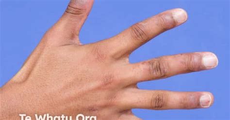 Atopic hand dermatitis image