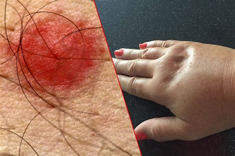 Wasp sting symptoms and treatments: Everything you need to know