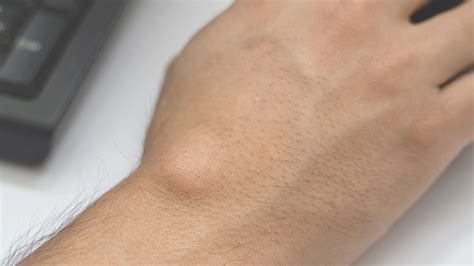 ganglion cyst symptoms   treatment private injection clinics