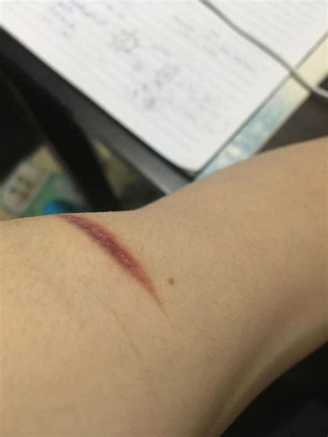 Why does it hurt when I rub my scar? The scars on my thigh doesn’t hurt