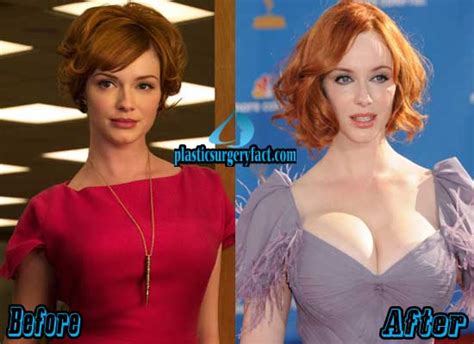 Christina Hendricks Plastic Surgery Before And After Photos