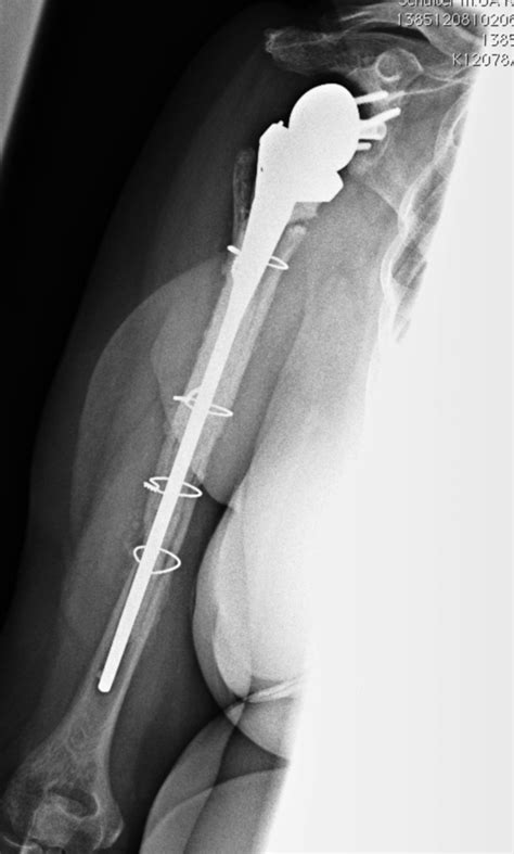 shoulder prosthesis