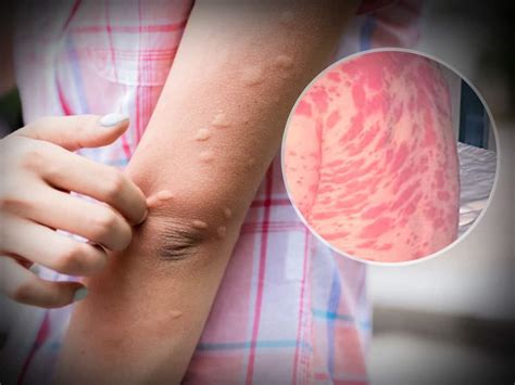 understanding urticaria   red  prickly bumps  skin