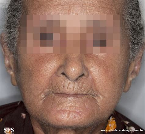 systemic sclerosis nc commons