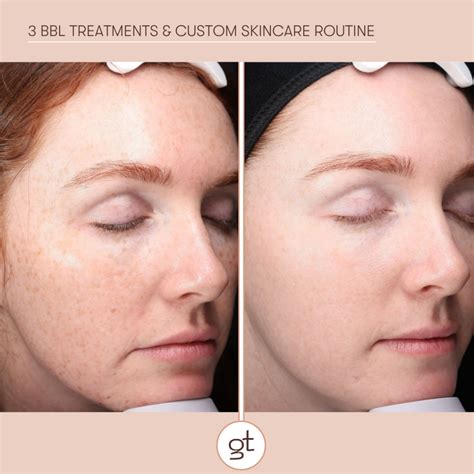 gallery  bbl hero photorejuvenation results