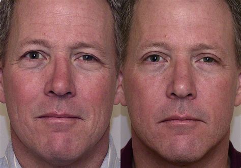 Eyelid Surgery (Blepharoplasty) Before and After Pictures Case 5