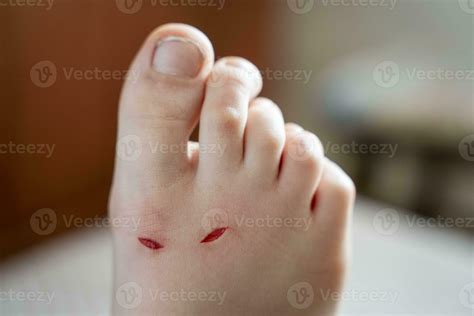 healing of bleeding wounds on a child's leg from cuts 23552615 Stock