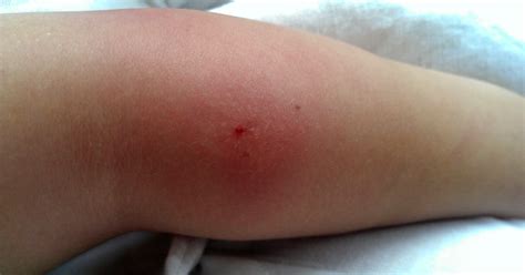 doctor   infected insect bite