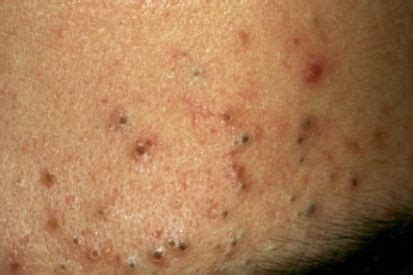 acne   treatment pinehurst dermatology