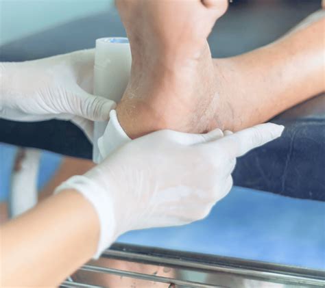 Comprehensive Diabetic Foot Ulcer Management in Quezon City – Kalingap ...