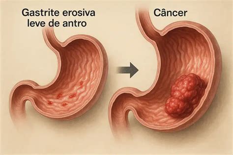 Gastrite Enantematosa Leve De Antro Pode Virar Cancer