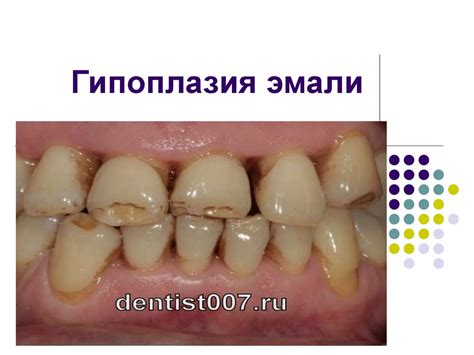 Гипоплазия эмали - презентация онлайн