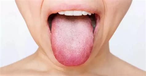 O Que Significa Língua Branca - Língua Branca: Como Tratar _ Língua branca: saiba o que é e como tratar ...