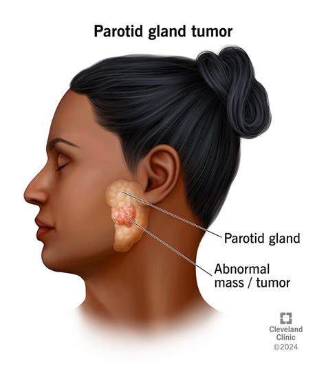 parotid gland tumors symptoms  treatment