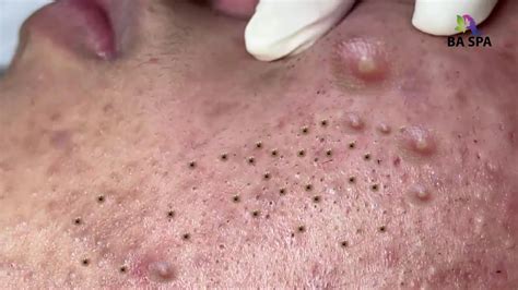 Unbelievable Blackhead Removal 2024: A Comprehensive Overview - 3f0wjfx