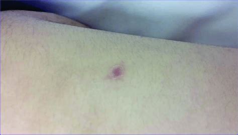 eschar   flank  scientific diagram