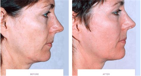 Laser Skin Tightening before and after - Thermage, Morpheus8, Ultherapy ...