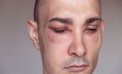 navigating  swell understanding  managing swelling