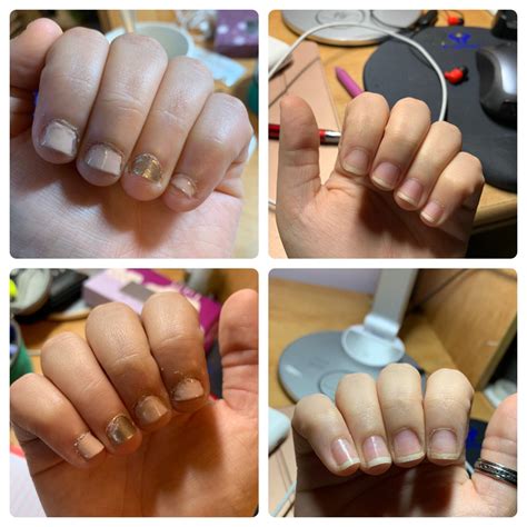 One month clean- I never thought that my nails would look like this. I