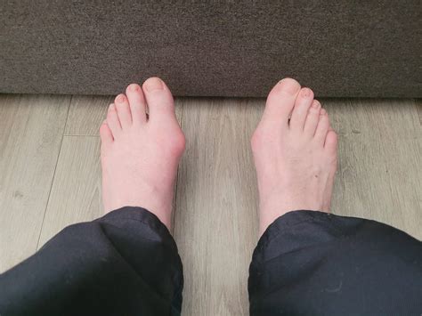 138 best r/bunions images on Pholder | 16 days post op