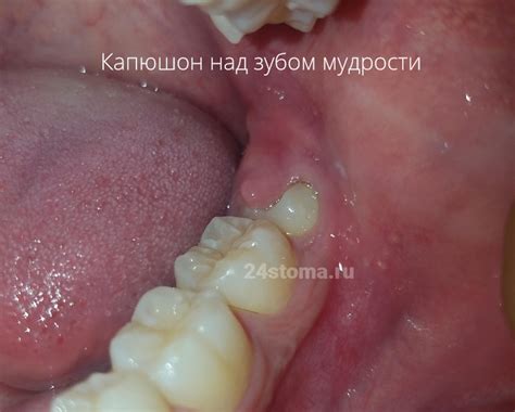 Зуб мудрости растет и болит десна – что делать, быстрая помощь