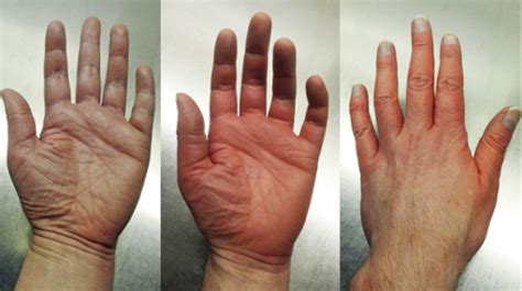 chpt  management  pts  hematologic blood neoplasms type