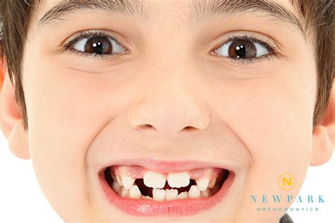 Hypodontia (Missing Teeth): Causes Treatment, 47% OFF