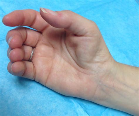 Thenar Muscle Atrophy | Hand Surgery Resource