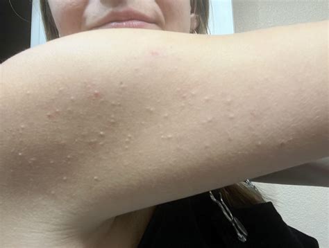 Anyone know what these bumps on my arm could be? : r/SkincareAddicts
