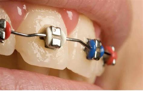 Що потрібно знати про металеві брекети - Cтоматологія Dentalknysh