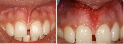 Френулотомия | Новини | Dental.bg