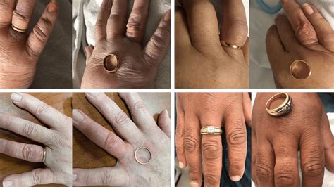 ring rescue kit stuck ring removal solution
