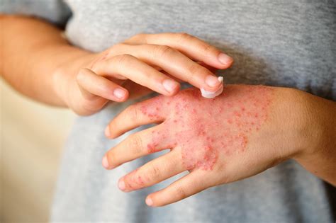 AAAAI: Twice-Daily Ruxolitinib Cream Improves Atopic Dermatitis Severity