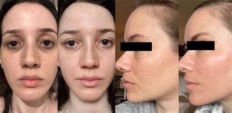 hydroquinone cream