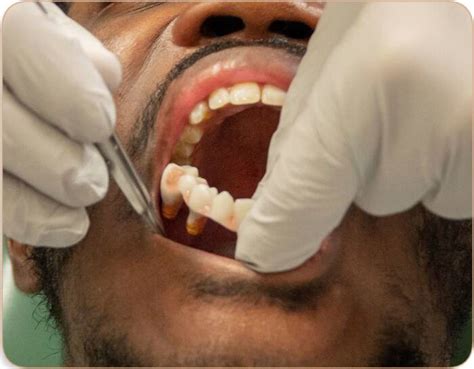 how to clean dentures stains