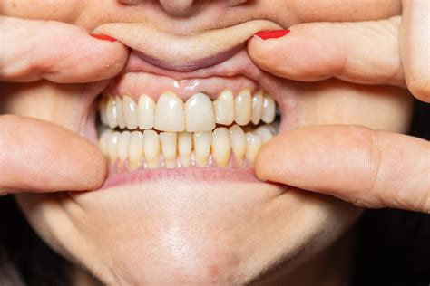 Significantly Effective Ways to Prevent Gum Receding