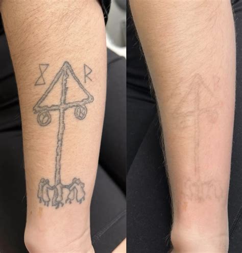 does tattoo removal hurt 12