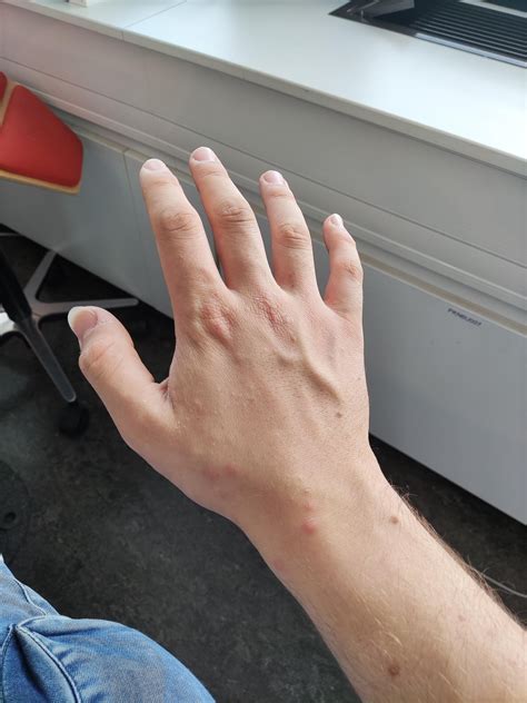 Itchy red bumps on hands and small bumps on feet : r/DiagnoseMe