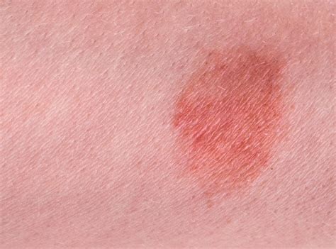 Premium Photo | The great red spot on the skin closeup.